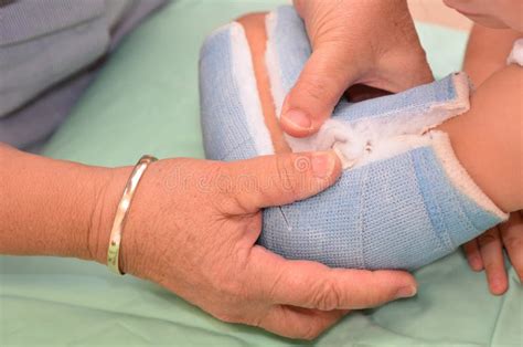 Cast removal stock image. Image of broken, medicine, insurance - 39386759