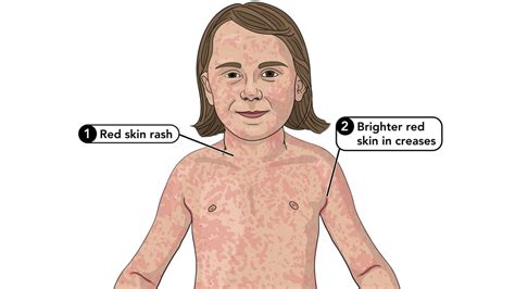 Symptoms of Scarlet Fever | Group A Strep | CDC