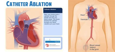 catheter-ablation-video-animation