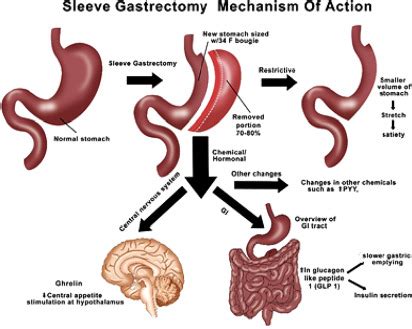 Laparoscopic Vertical Sleeve Gastrectomy - Surgical Clinics