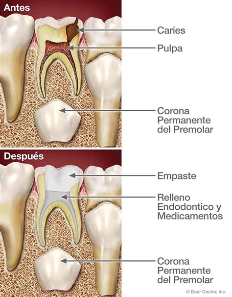 🏡 Qué debe saber antes de su primer canal radicular