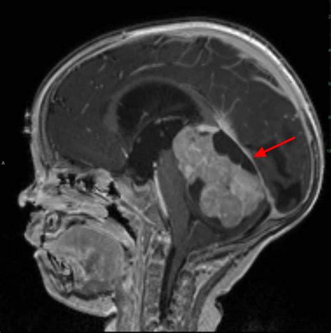 Medulloblastoma Cancer - Causes, Symptoms, Prognosis & Treatment