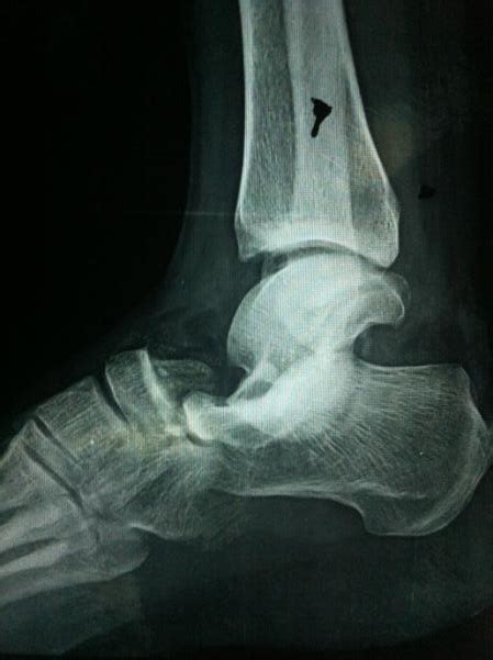 Lateral subtalar dislocation: A case report | The Foot and Ankle Online Journal