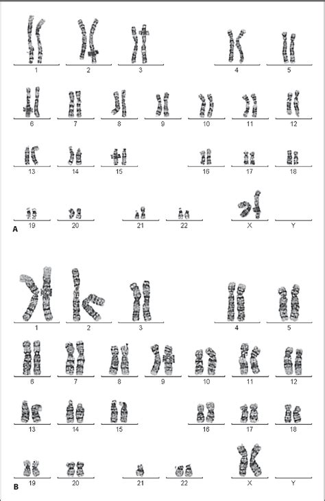 Monosomy 21