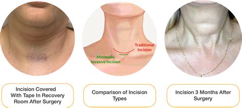 Goiter Removal