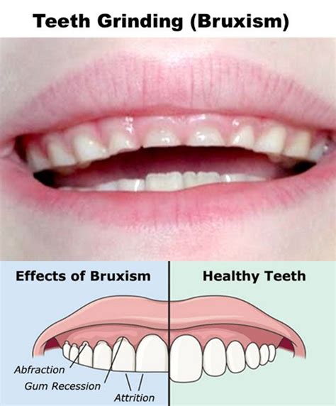 Nighttime Teeth Grinding (Bruxism) in Children – The Kids Dentist