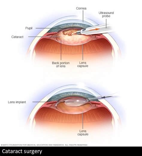 Ophthalmology Expert Witness Services