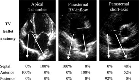 tricuspid valve echo - Google Search | Tricuspid valve, Leaflet, Valve