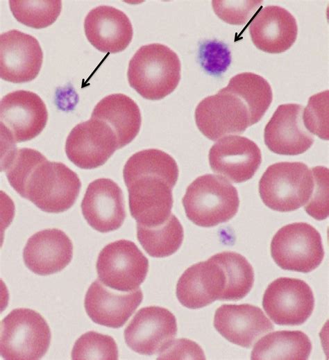 DNA-based Diagnosis of Uncharacterized Inherited Macrothrombocytopenias Using Next-generation ...