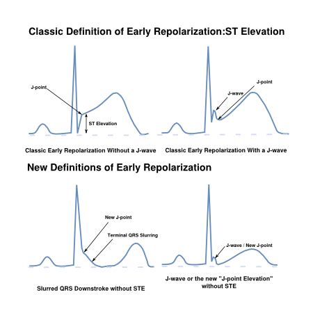 ST Morphology - ECGpedia