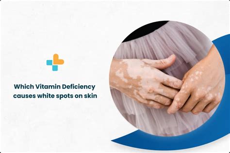 Which Vitamin Deficiency Causes White Spots On Skin - Ayu Health