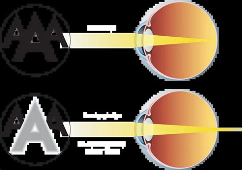 Chicago Presbyopia Treatment | Near Vision Loss Chicagoland IL