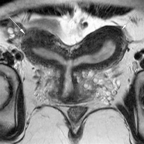 Bicornuate uterus as seen on a coronal MRI (normal variant) | Radiology, Mri, Bicornuate uterus