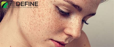 Laser Treatment For Freckles Cost In India | Laser Treatment In Hyderabad