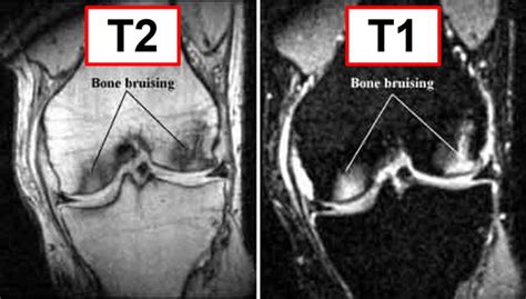 Bone Bruise - Causes, Symptoms, Diagnosis, Treatment & Healing Time