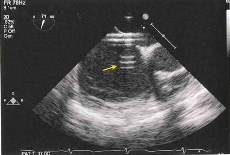 Pedi cardiology: Echo artifacts