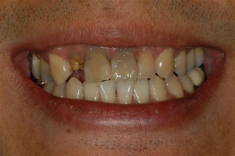 Discolored Teeth | Tetracycline Staining - Tysons Aesthetic Dentistry