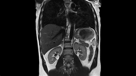 Body MRI - Siemens Healthineers