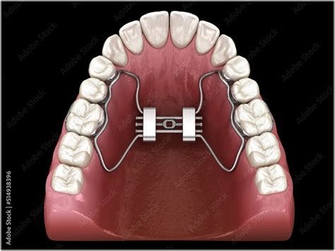 Quad Helix Orthodontics Miami | Quad Helix Expander Appliance