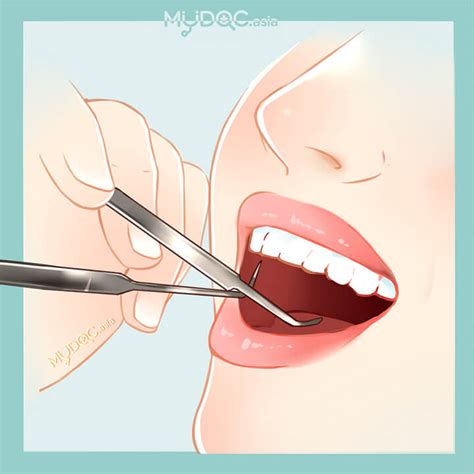 Best Teeth Scaling and Polishing, Bad Breath Treatment in Kuala Lumpur ...