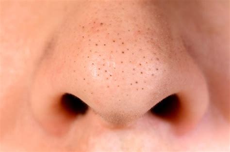 How to Treat Different Types of Acne | The Healthy