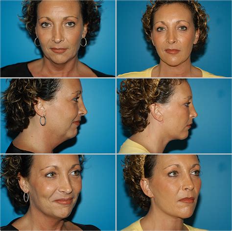 Before and After Plastic Surgery: Neck Lift | Naples Plastic Surgery