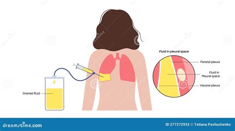 Thoracentesis Medical Procedure Cartoon Vector | CartoonDealer.com ...