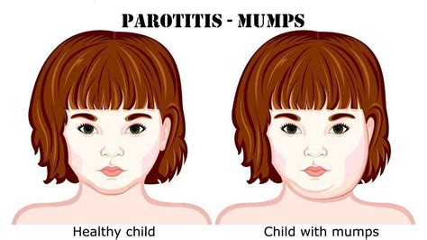 Parotitis