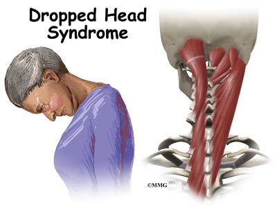 Dropped Head Syndrome - eOrthopod.com