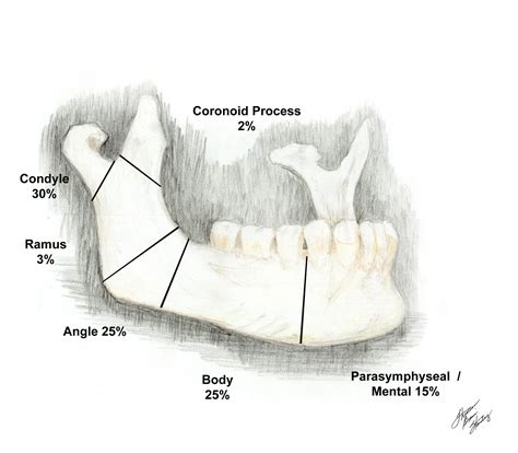 Most Common Sites of Mandible Fracture Copy - ECGcourse.com