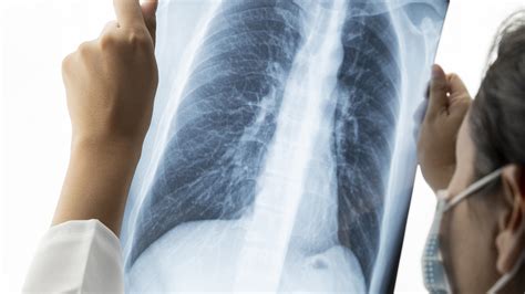 Healthy Lungs Vs Smokers Lungs X Ray