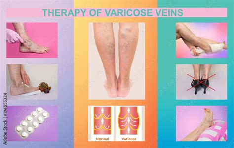 Treatment of varicose veins Stock Photo | Adobe Stock