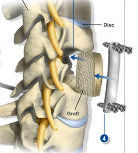 Corpectomy - Matthew D. Hepler, M.D.-Spine Surgeon Palm Beach County