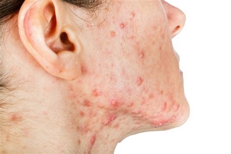 Skin Conditions That Are Commonly Mistaken for Acne