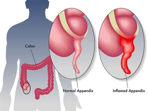 Acute Appendicitis - Causes, Treatment, Surgery - Heart Sense