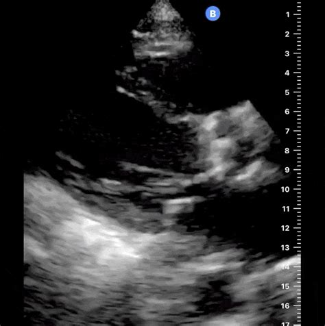 Heart Failure Echocardiogram Gif