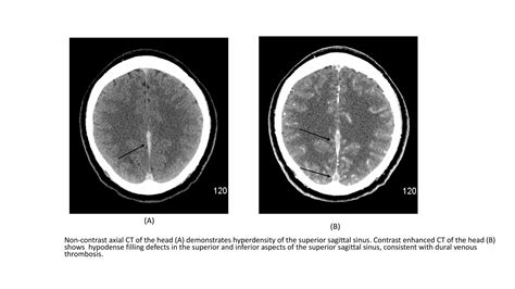 Cerebral Venous Sinus Thrombosis - Cerebral Venous Sinus Thrombosis Cvst Causes Risks ...