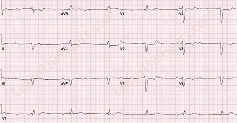 Complete 3rd Degree Heart Block Ecg - Photos Idea