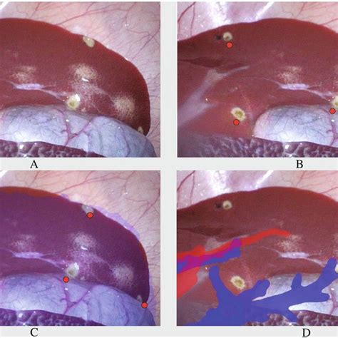 Pyloromyotomy throught the umbilical excission | Download Scientific ...