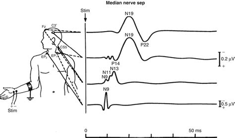 Prognostic Use of Somatosensory Evoked Potentials in Acute Consciousness Impairment | Neupsy Key