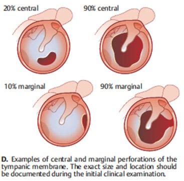 Tympanic membrane perforation (ReelDx) - Smarty PANCE