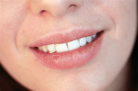 Eczema on Lips - How To Get Rid of Lip Eczema?