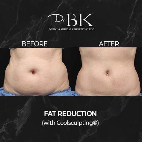 Coolsculpting® Fat Freezing Treatment - DrBK Clinic in Reading