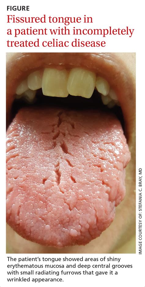 Red patches on the tongue with white borders • history of geographic tongue • incompletely ...