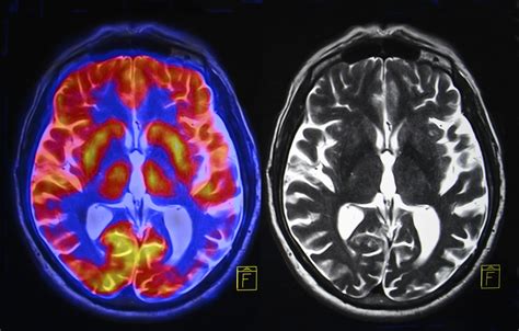 Scans reveal brain’s reaction when addicts think about drugs | Matrix Diagnostics