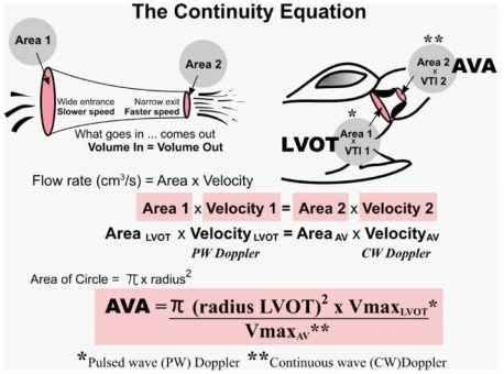 Fig. 11. The continuity equation and assumptions for measuring aortic valve area (AVA) in aorti ...