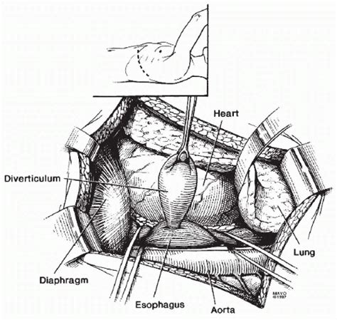 Epiphrenic Diverticulum | Thoracic Key