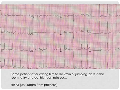 Benign Early Repolarization