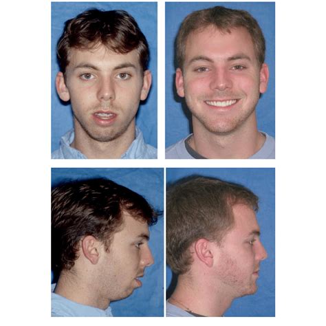 Before and After Photos Maxillofacial Surgery - Larry M. Wolford, DMD