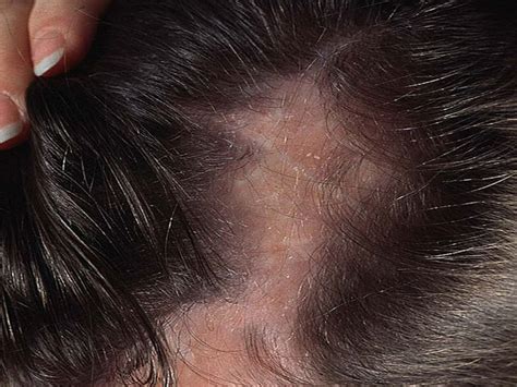 What is Scarring Alopecia | Causes, Symptoms & Treatments